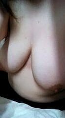 40F الثدي المترهل